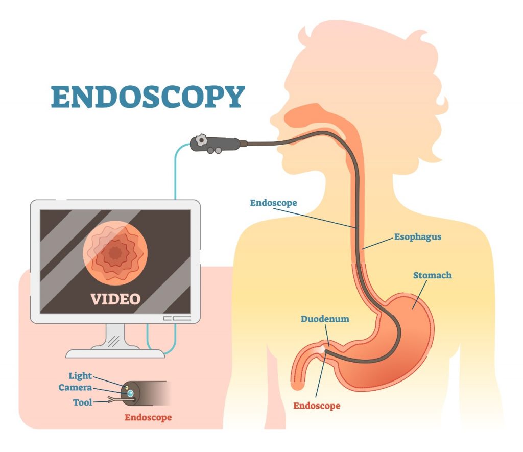 Gastroscopy Procedure & Cost Singapore [2023] | Nexus Surgical